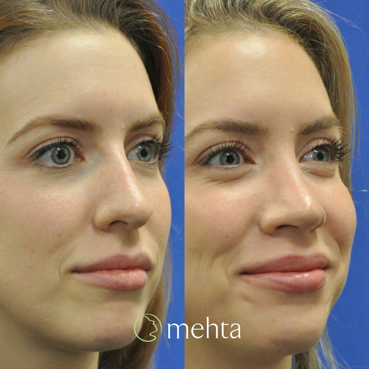 Rhinoplasty Before & After Gallery - Patient 158836 - Image 4