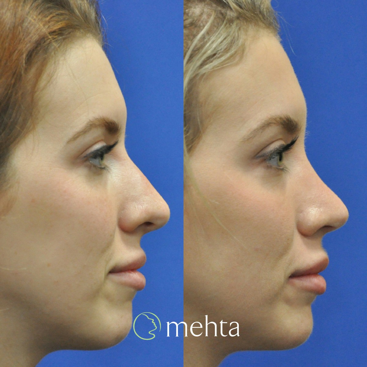 Rhinoplasty Before & After Gallery - Patient 158836 - Image 5