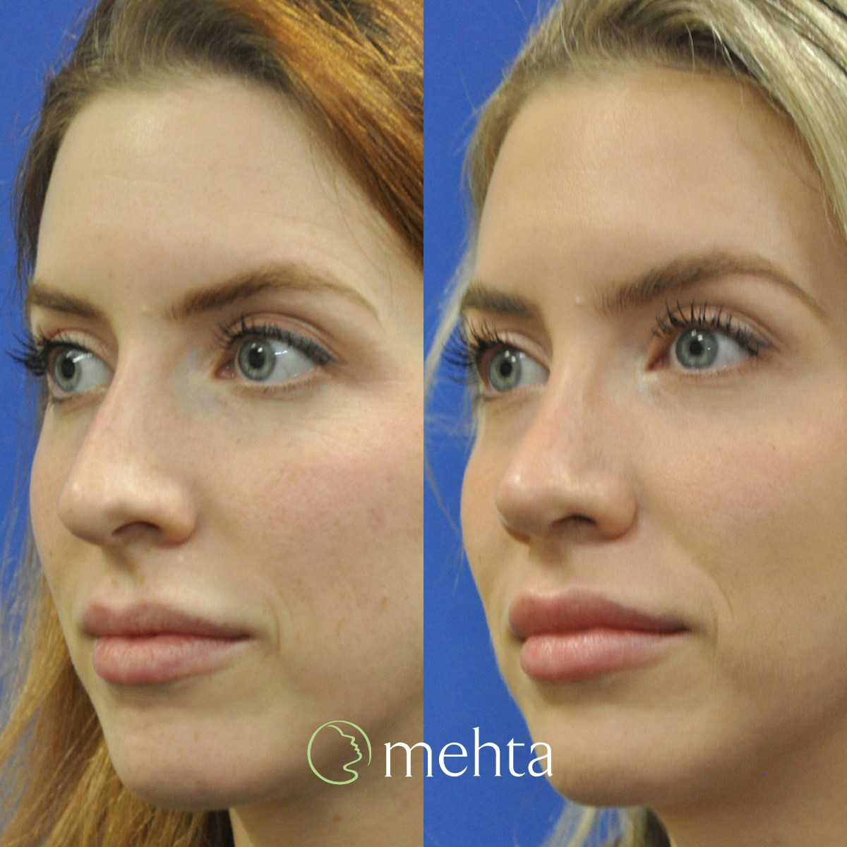 Rhinoplasty Before & After Gallery - Patient 158836 - Image 7