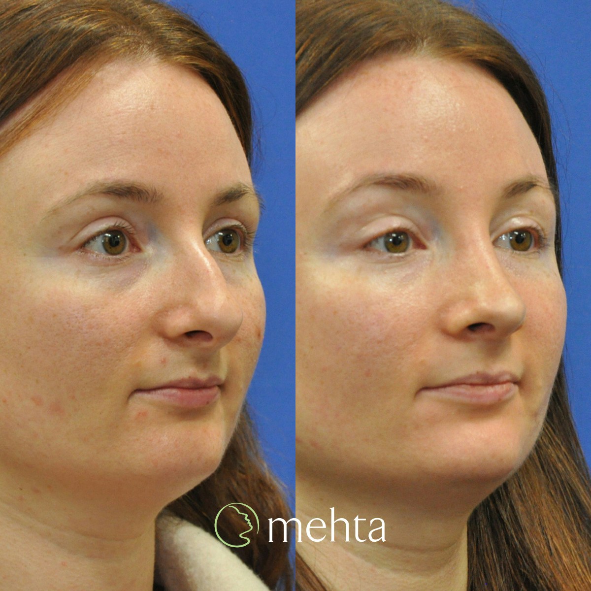 Rhinoplasty Before & After Gallery - Patient 259026 - Image 3