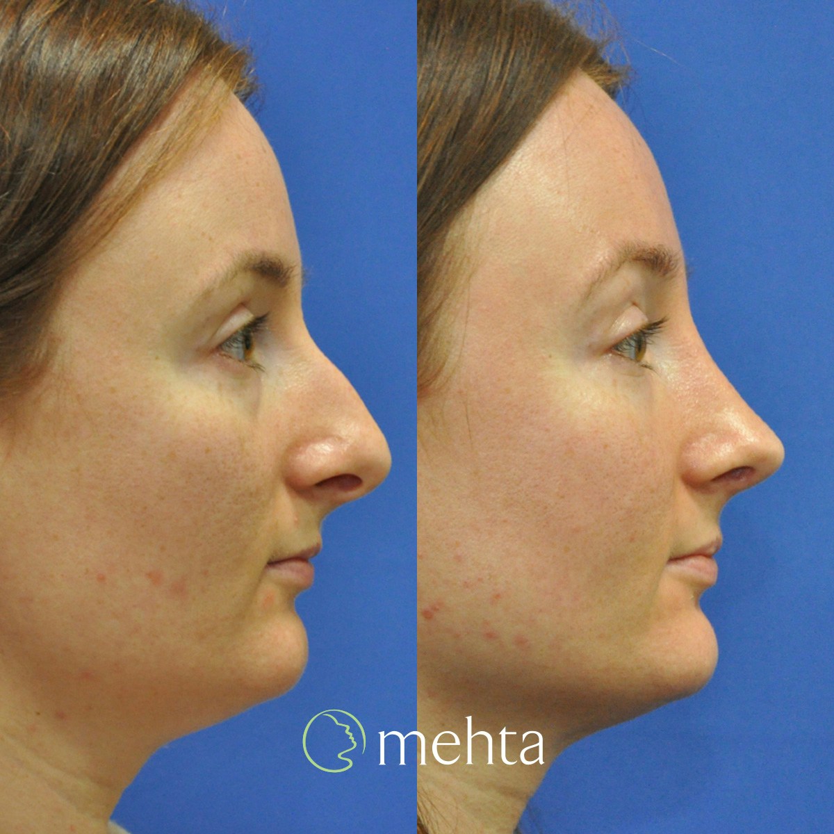 Rhinoplasty Before & After Gallery - Patient 259026 - Image 4