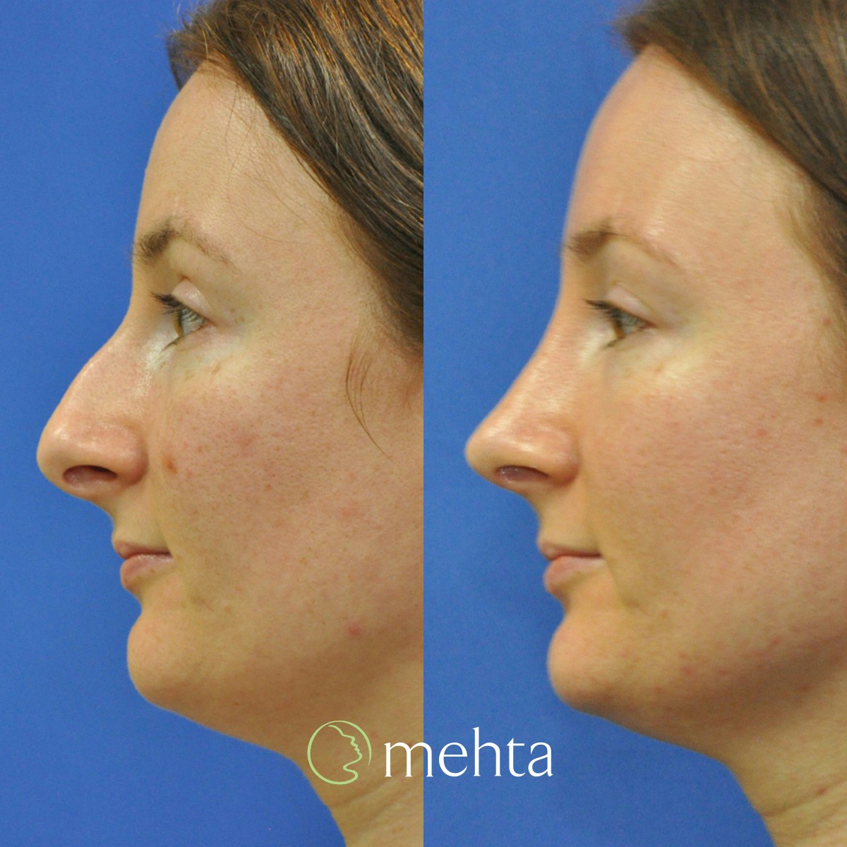 Rhinoplasty Before & After Gallery - Patient 259026 - Image 1