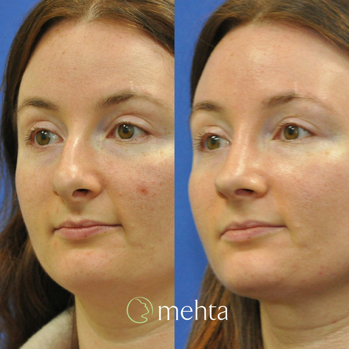 Rhinoplasty Before & After Gallery - Patient 259026 - Image 5
