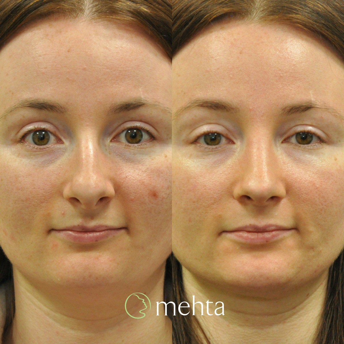 Rhinoplasty Before & After Gallery - Patient 259026 - Image 2