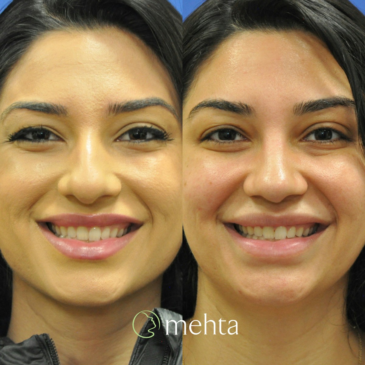Rhinoplasty Before & After Gallery - Patient 140846 - Image 4