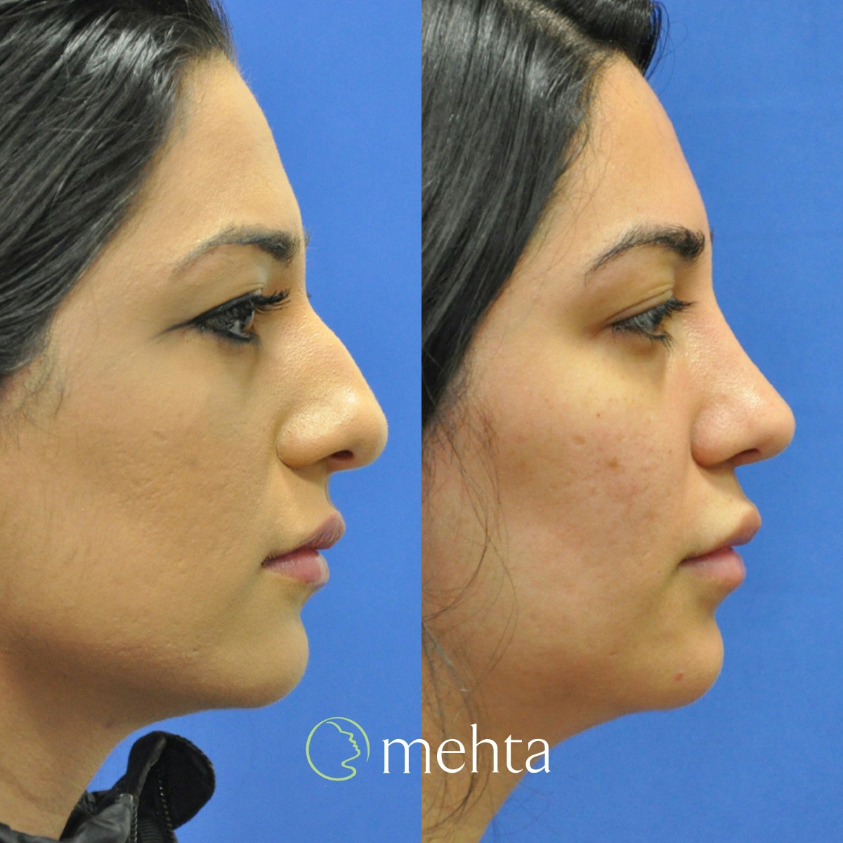 Rhinoplasty Before & After Gallery - Patient 140846 - Image 5