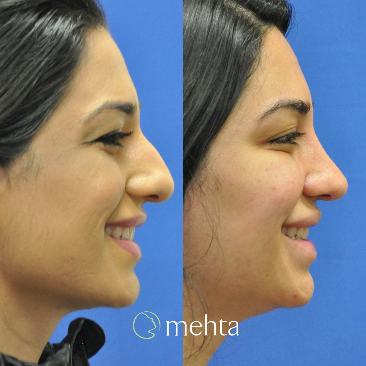Rhinoplasty Before & After Gallery - Patient 140846 - Image 6