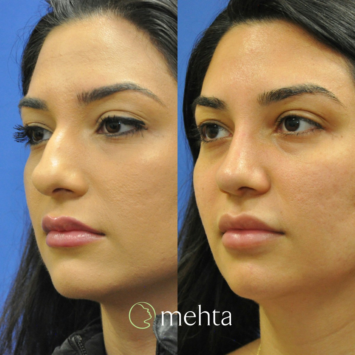 Rhinoplasty Before & After Gallery - Patient 140846 - Image 2