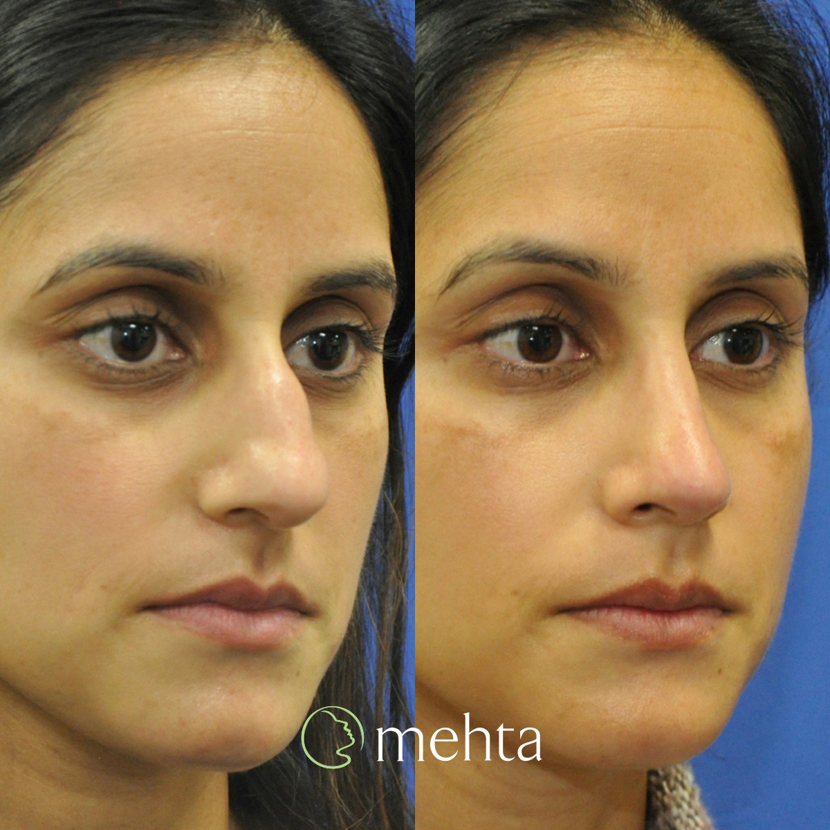 Rhinoplasty Before & After Gallery - Patient 261597 - Image 4