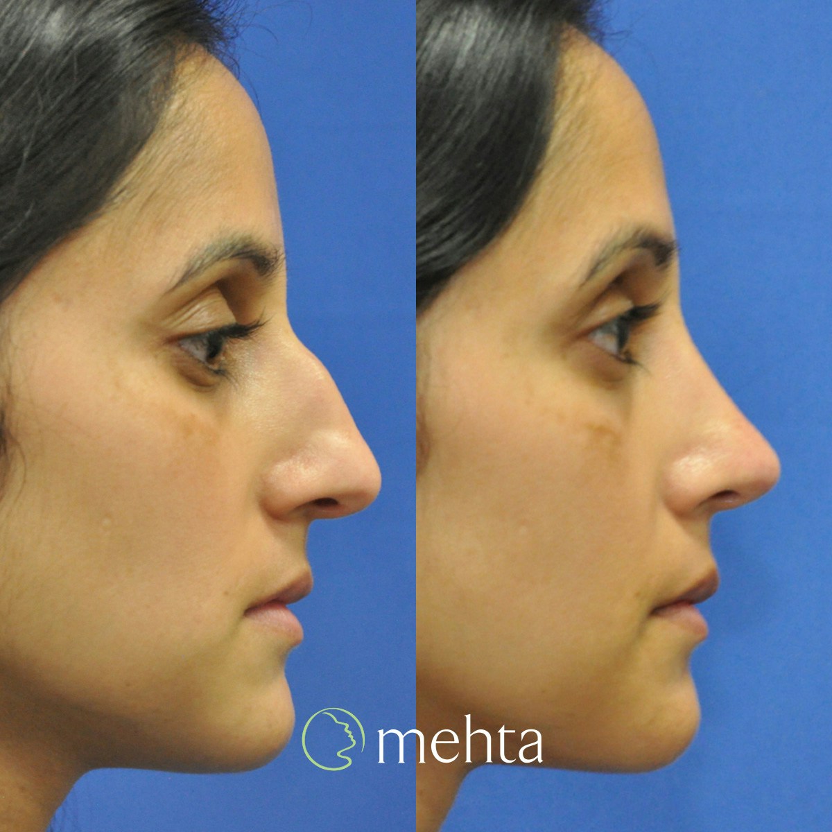 Rhinoplasty Before & After Gallery - Patient 261597 - Image 5