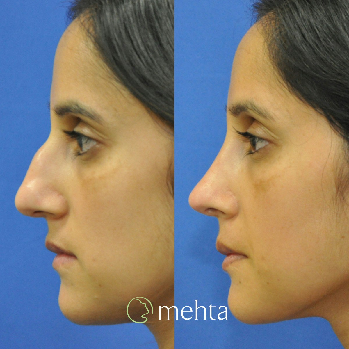 Rhinoplasty Before & After Gallery - Patient 261597 - Image 1