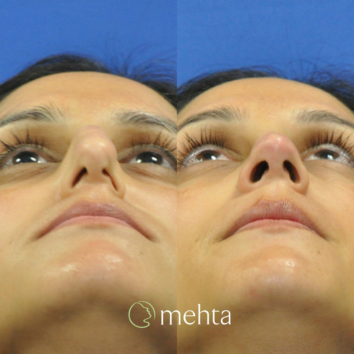 Rhinoplasty Before & After Gallery - Patient 261597 - Image 6