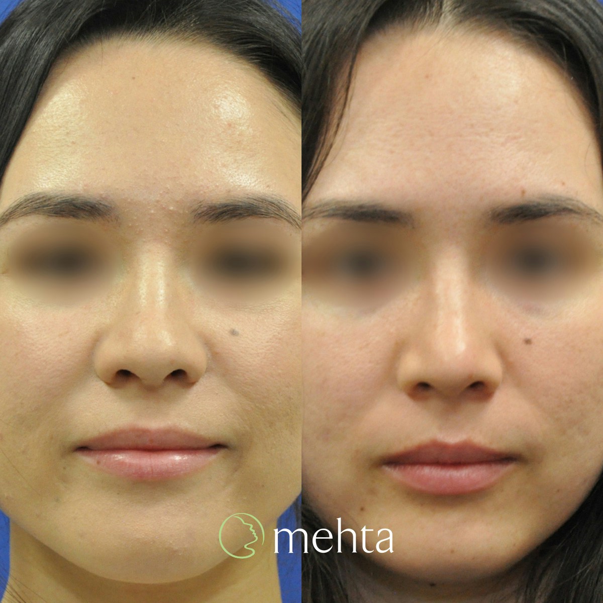 Rhinoplasty Before & After Gallery - Patient 823590 - Image 3