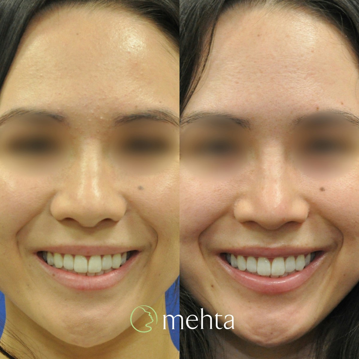 Rhinoplasty Before & After Gallery - Patient 823590 - Image 4