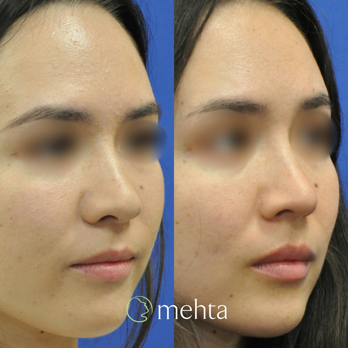 Rhinoplasty Before & After Gallery - Patient 823590 - Image 5