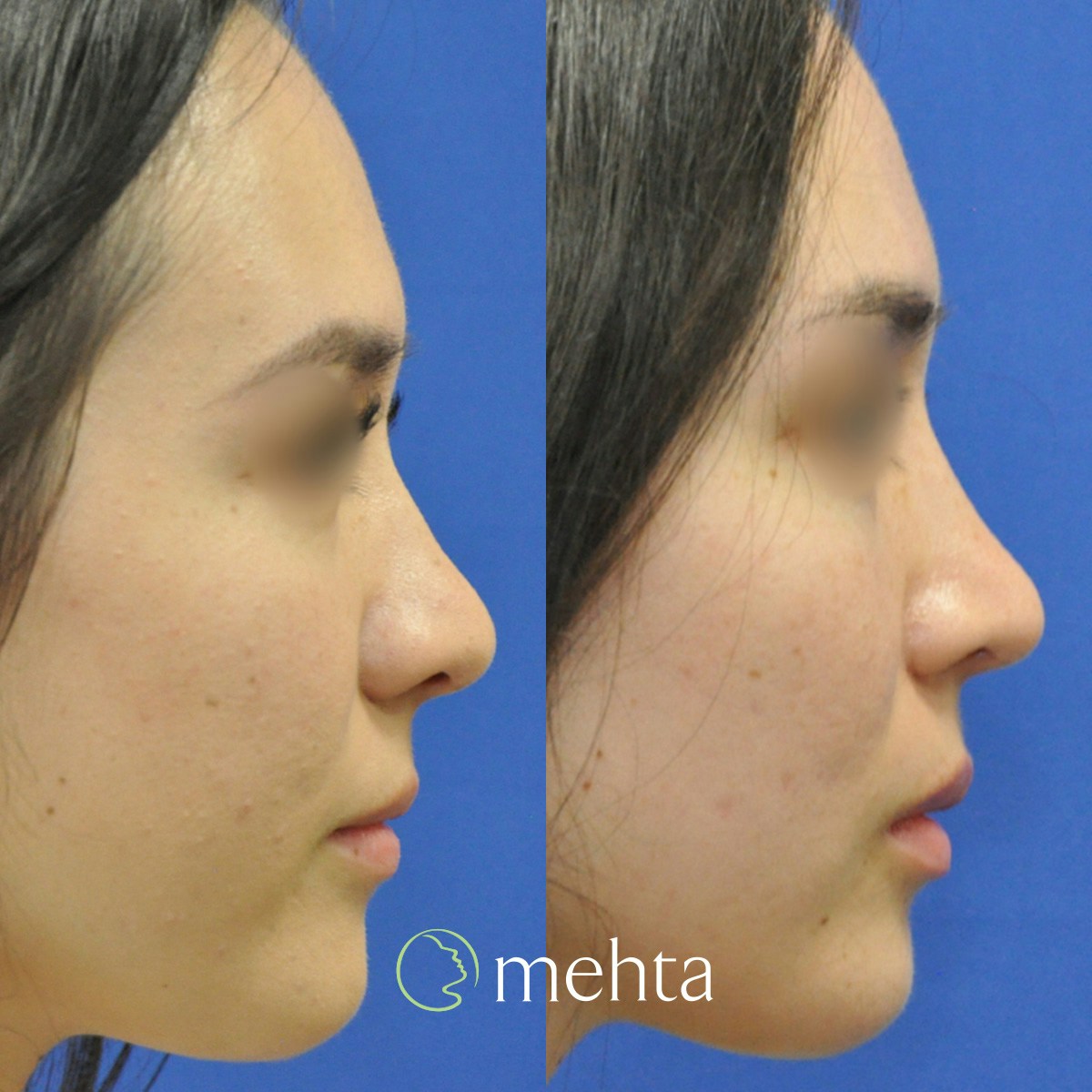 Rhinoplasty Before & After Gallery - Patient 823590 - Image 1