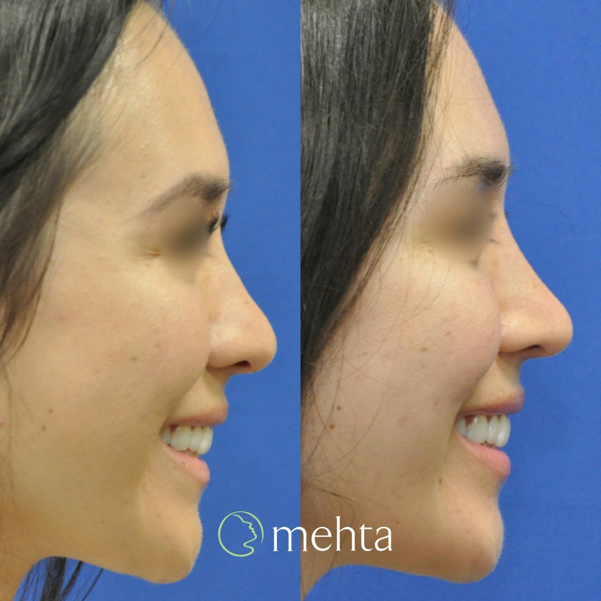 Rhinoplasty Before & After Gallery - Patient 823590 - Image 2