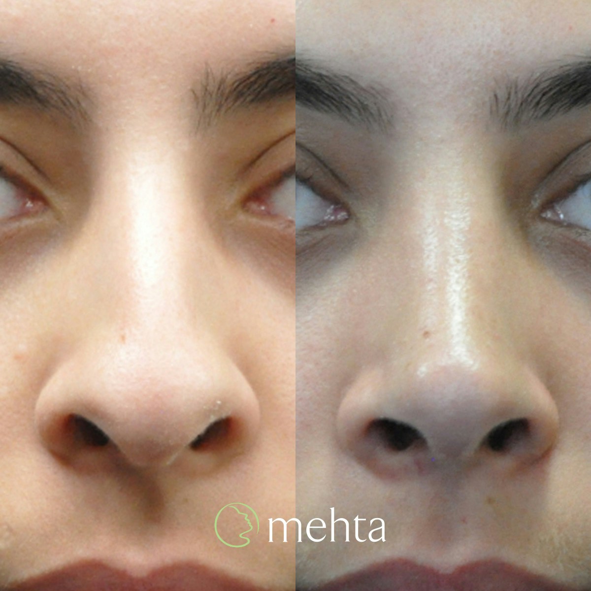 Rhinoplasty Before & After Gallery - Patient 808279 - Image 3