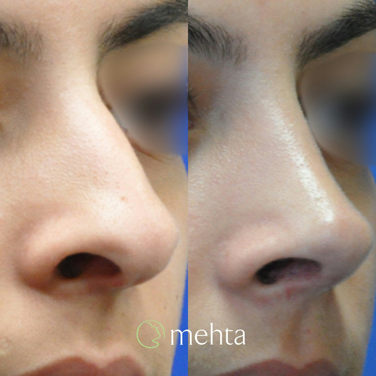Rhinoplasty Before & After Gallery - Patient 808279 - Image 4