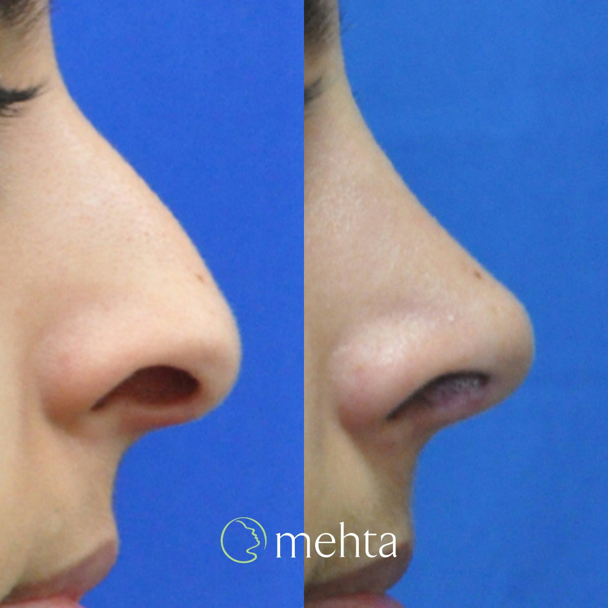 Rhinoplasty Before & After Gallery - Patient 808279 - Image 5