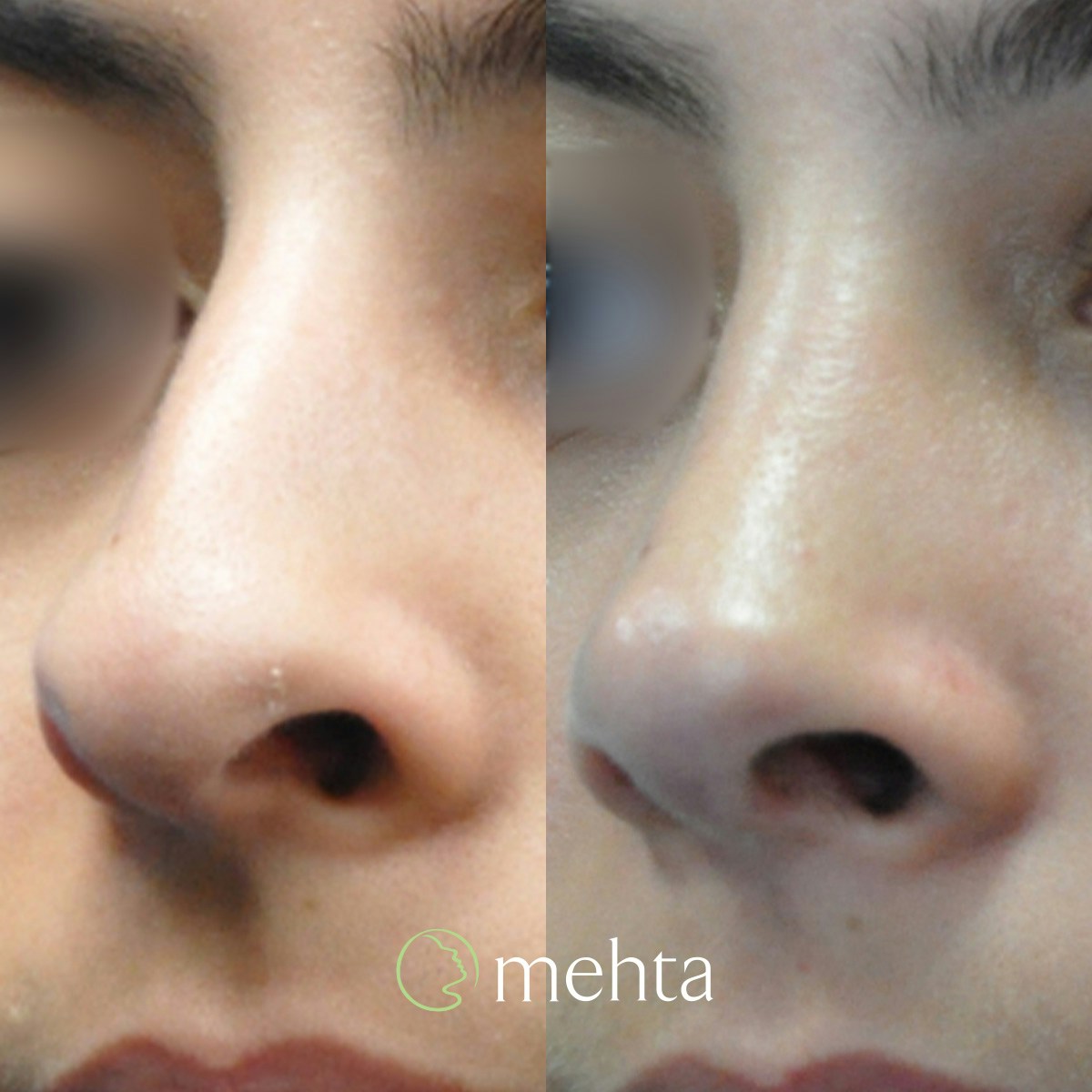 Rhinoplasty Before & After Gallery - Patient 808279 - Image 2