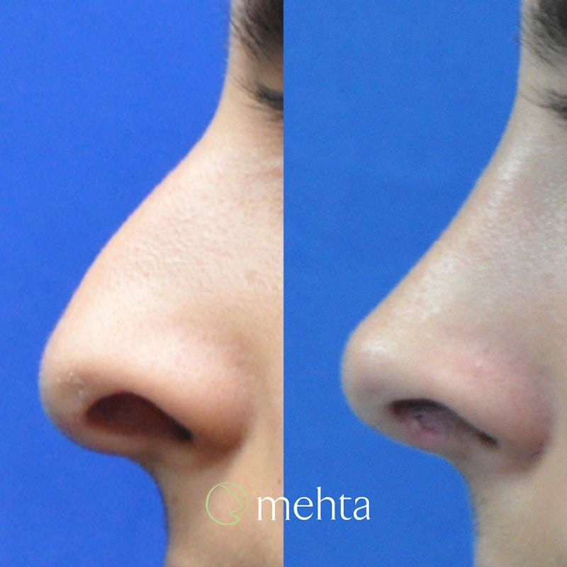 Rhinoplasty Before & After Gallery - Patient 808279 - Image 1
