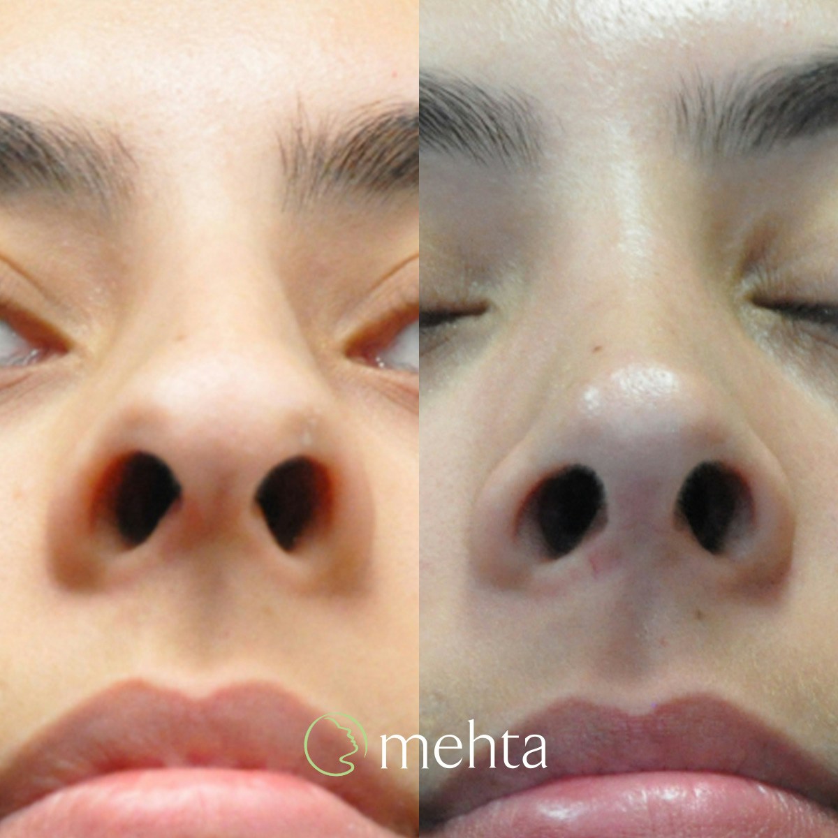 Rhinoplasty Before & After Gallery - Patient 808279 - Image 6