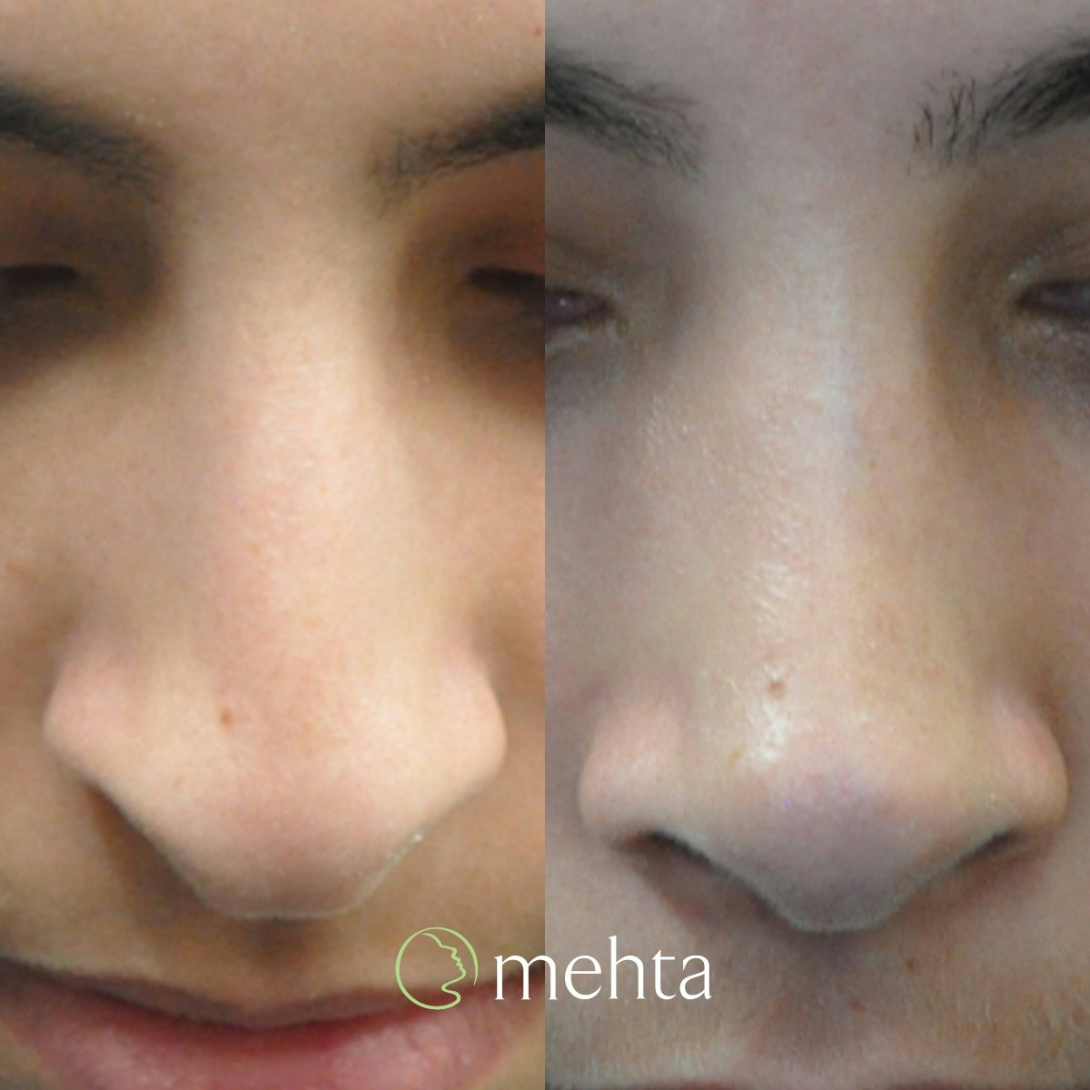 Rhinoplasty Before & After Gallery - Patient 808279 - Image 7