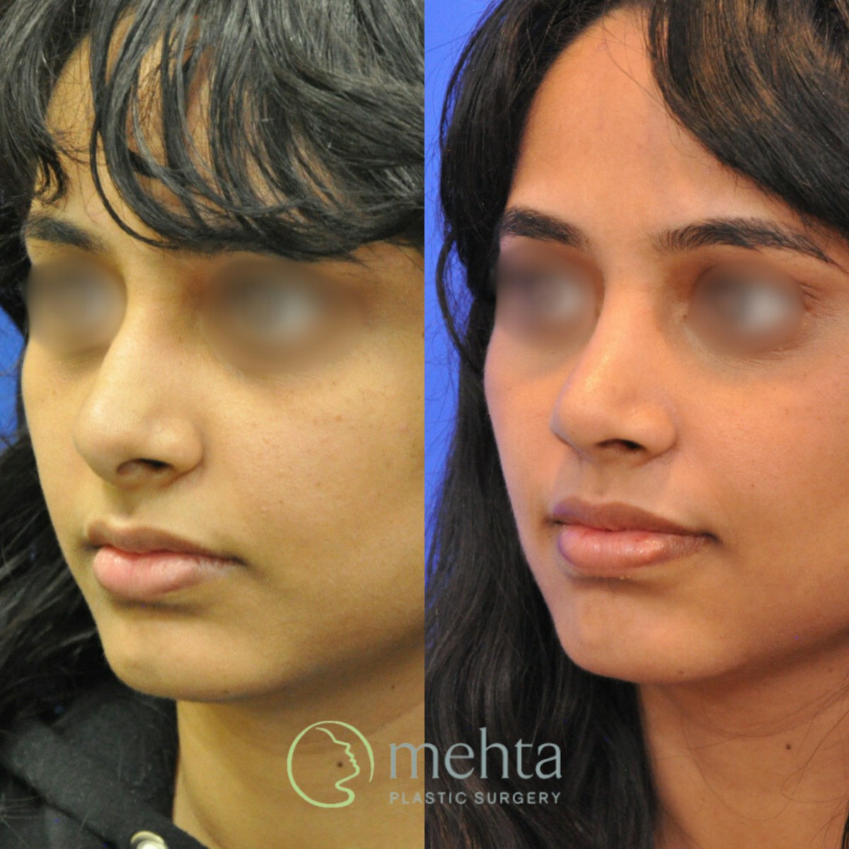 Rhinoplasty Before & After Gallery - Patient 248394 - Image 2