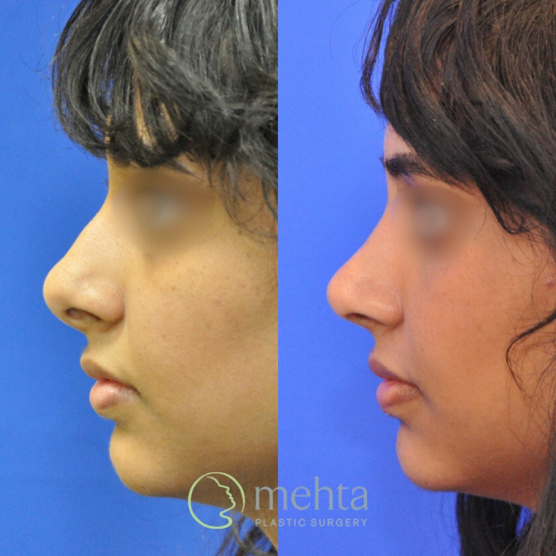 Rhinoplasty Before & After Gallery - Patient 248394 - Image 1