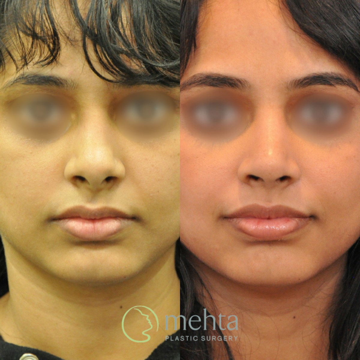 Rhinoplasty Before & After Gallery - Patient 248394 - Image 3