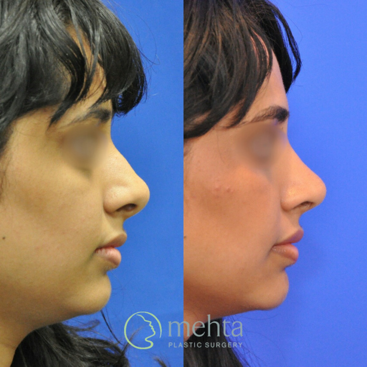 Rhinoplasty Before & After Gallery - Patient 248394 - Image 5