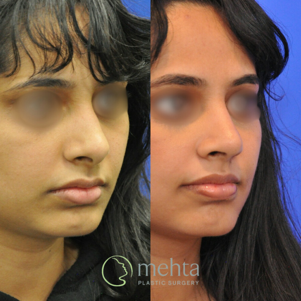 Rhinoplasty Before & After Gallery - Patient 248394 - Image 4