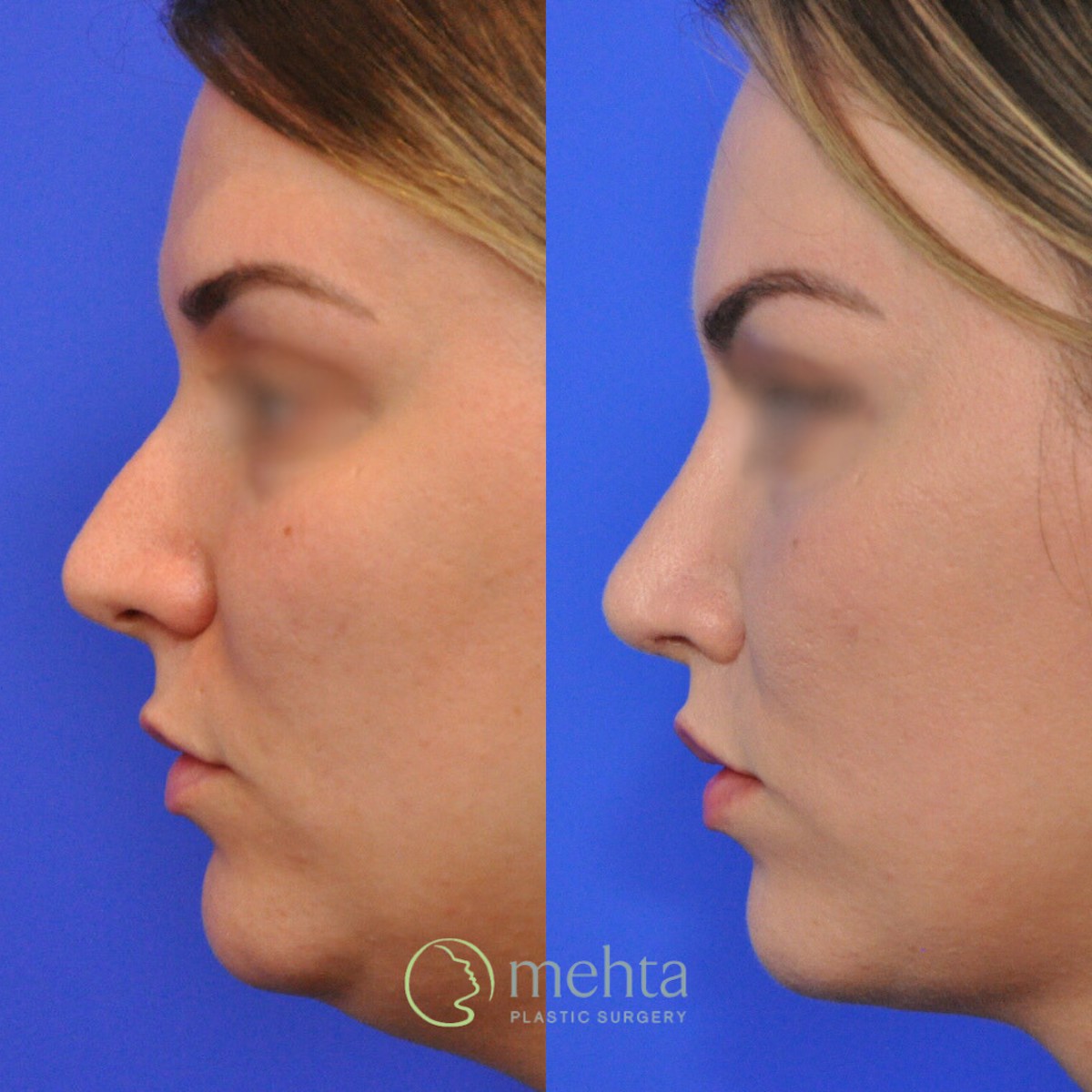 Rhinoplasty Before & After Gallery - Patient 185257 - Image 1