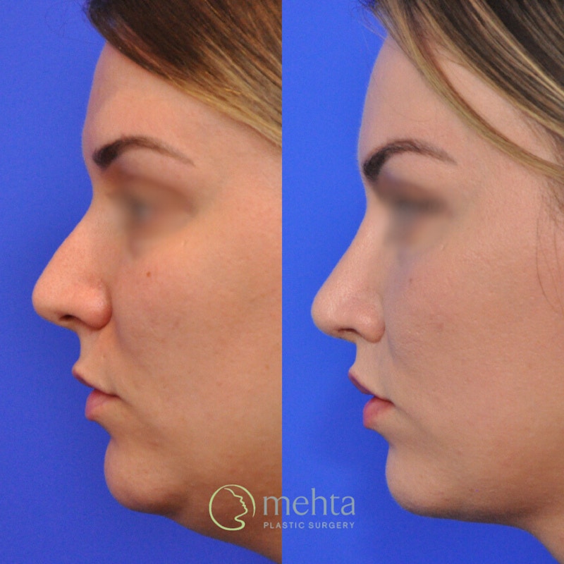 Rhinoplasty Before & After Gallery - Patient 185257 - Image 1