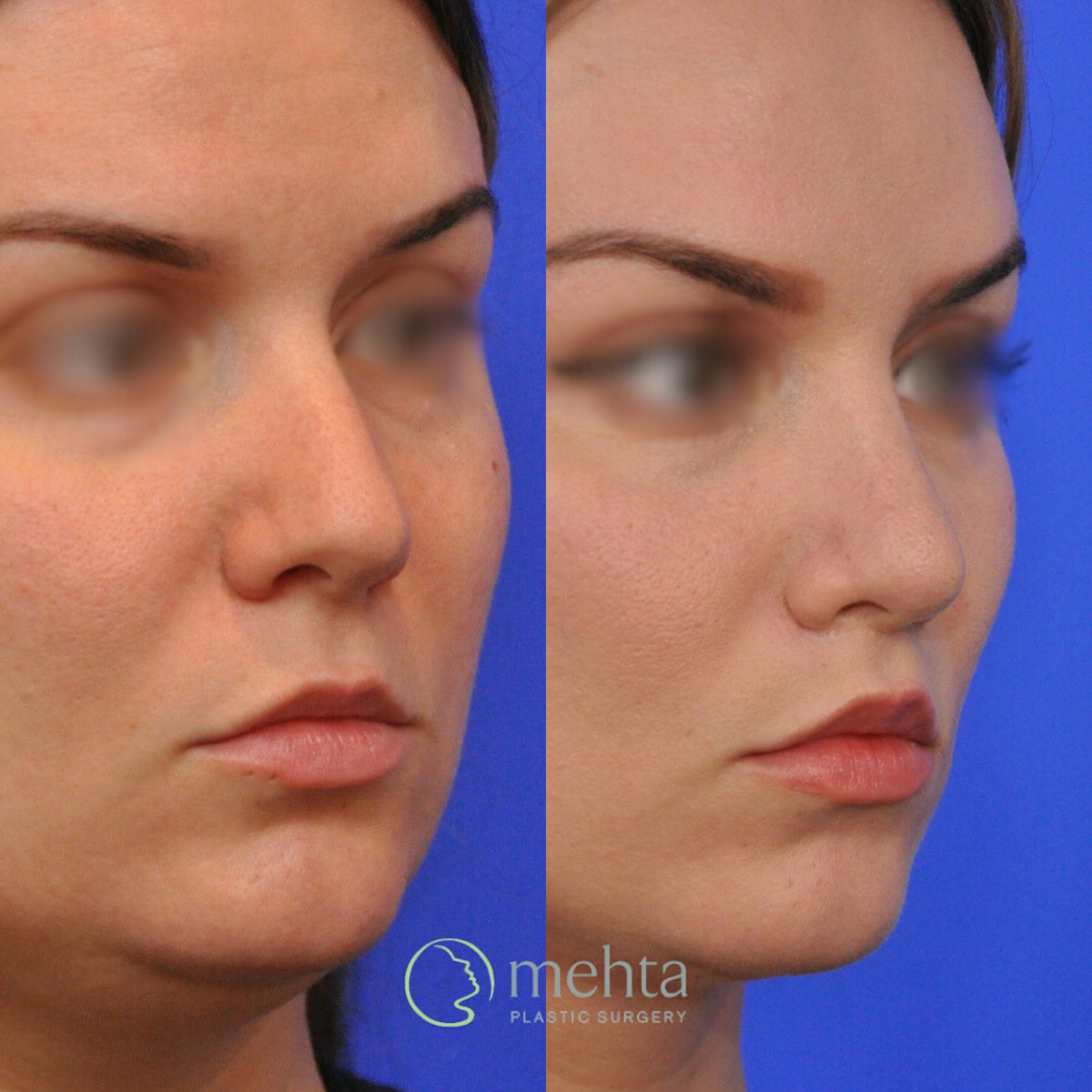 Rhinoplasty Before & After Gallery - Patient 185257 - Image 3
