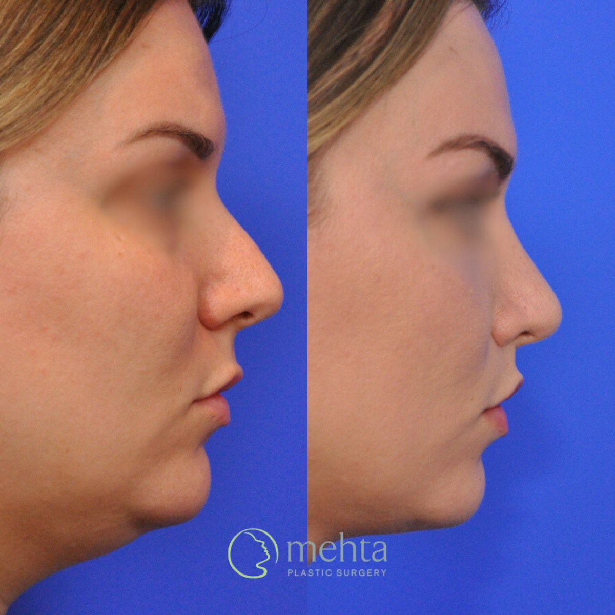 Rhinoplasty Before & After Gallery - Patient 185257 - Image 4