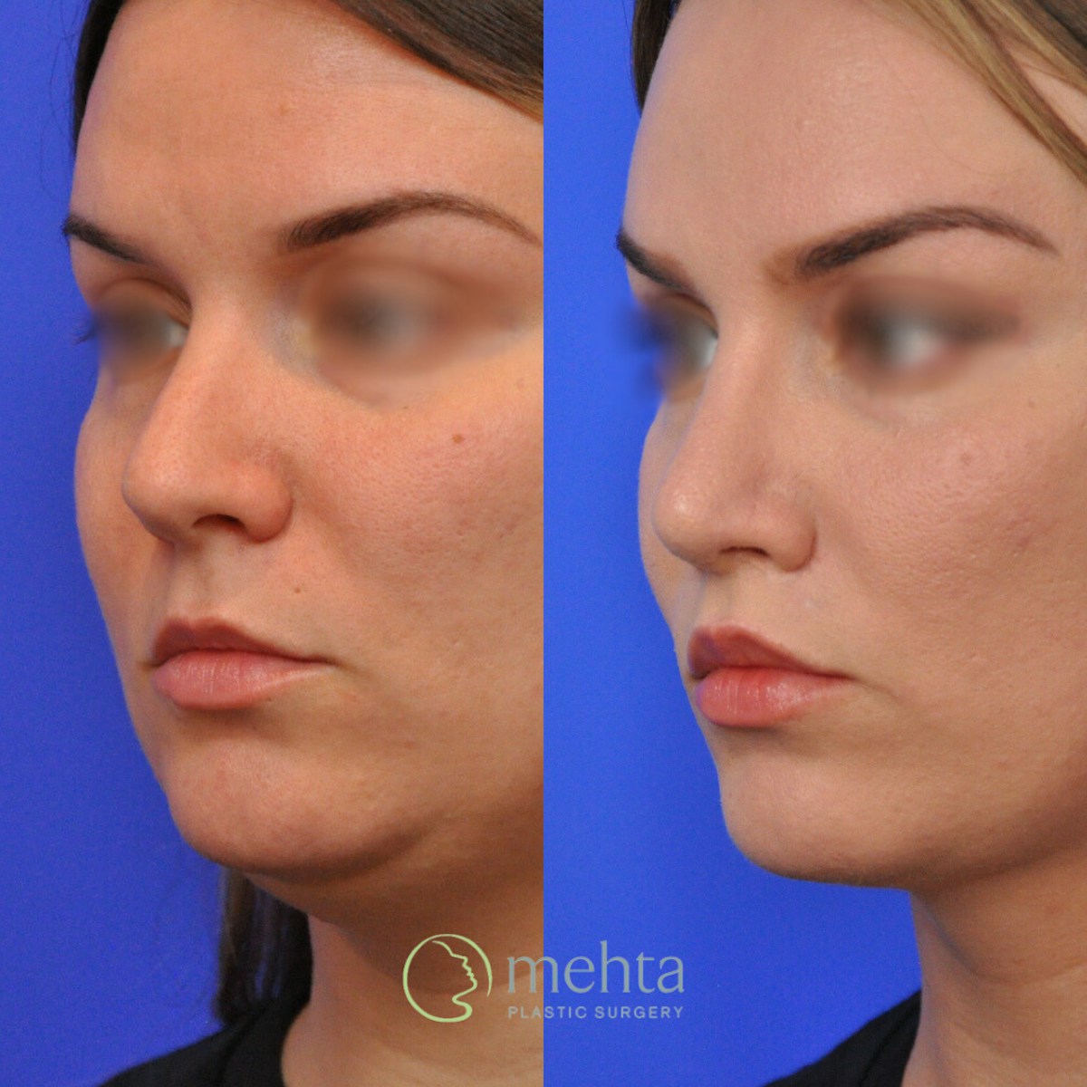 Rhinoplasty Before & After Gallery - Patient 185257 - Image 2