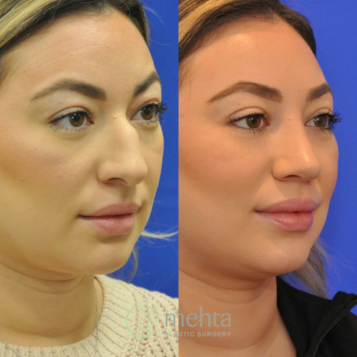Rhinoplasty Before & After Gallery - Patient 402966 - Image 3