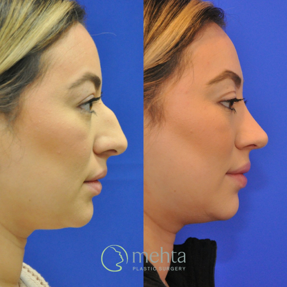 Rhinoplasty Before & After Gallery - Patient 402966 - Image 2