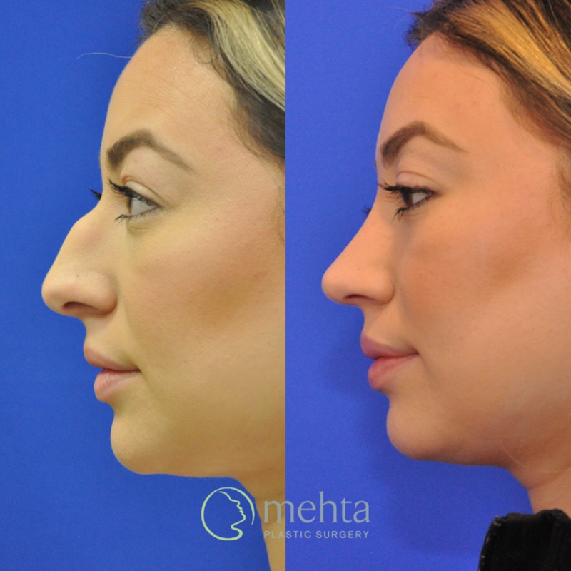 Rhinoplasty Before & After Gallery - Patient 402966 - Image 1