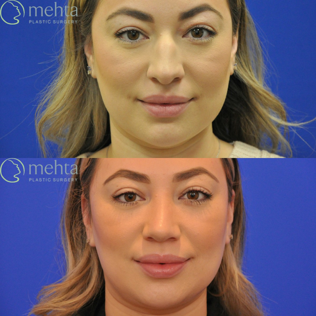Rhinoplasty Before & After Gallery - Patient 402966 - Image 4