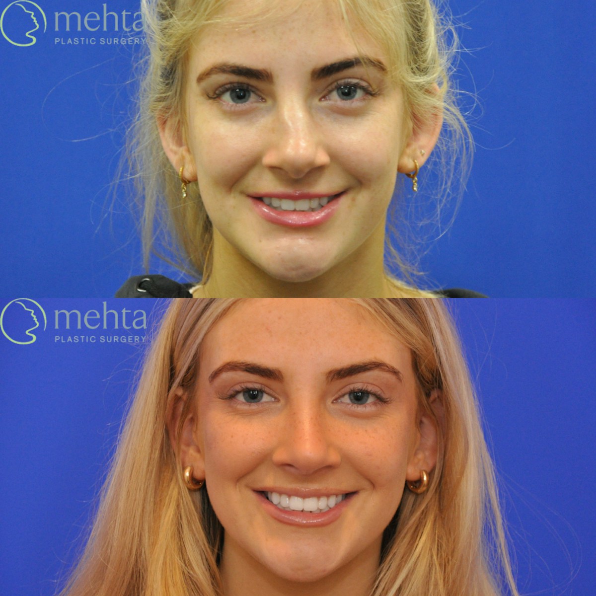 Rhinoplasty Before & After Gallery - Patient 564513 - Image 6