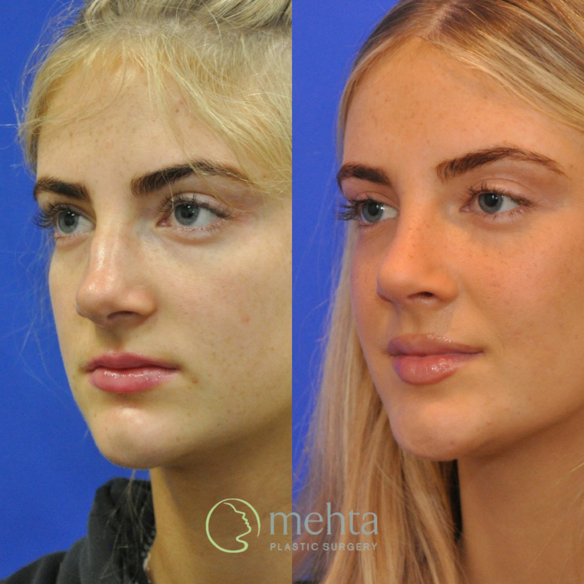 Rhinoplasty Before & After Gallery - Patient 564513 - Image 2