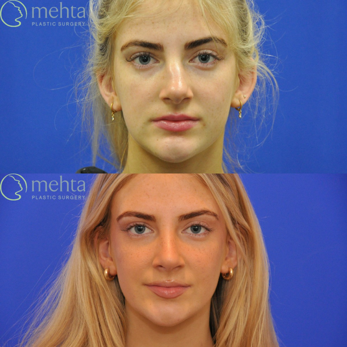 Rhinoplasty Before & After Gallery - Patient 564513 - Image 7