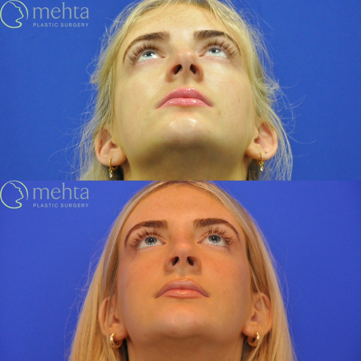 Rhinoplasty Before & After Gallery - Patient 564513 - Image 8