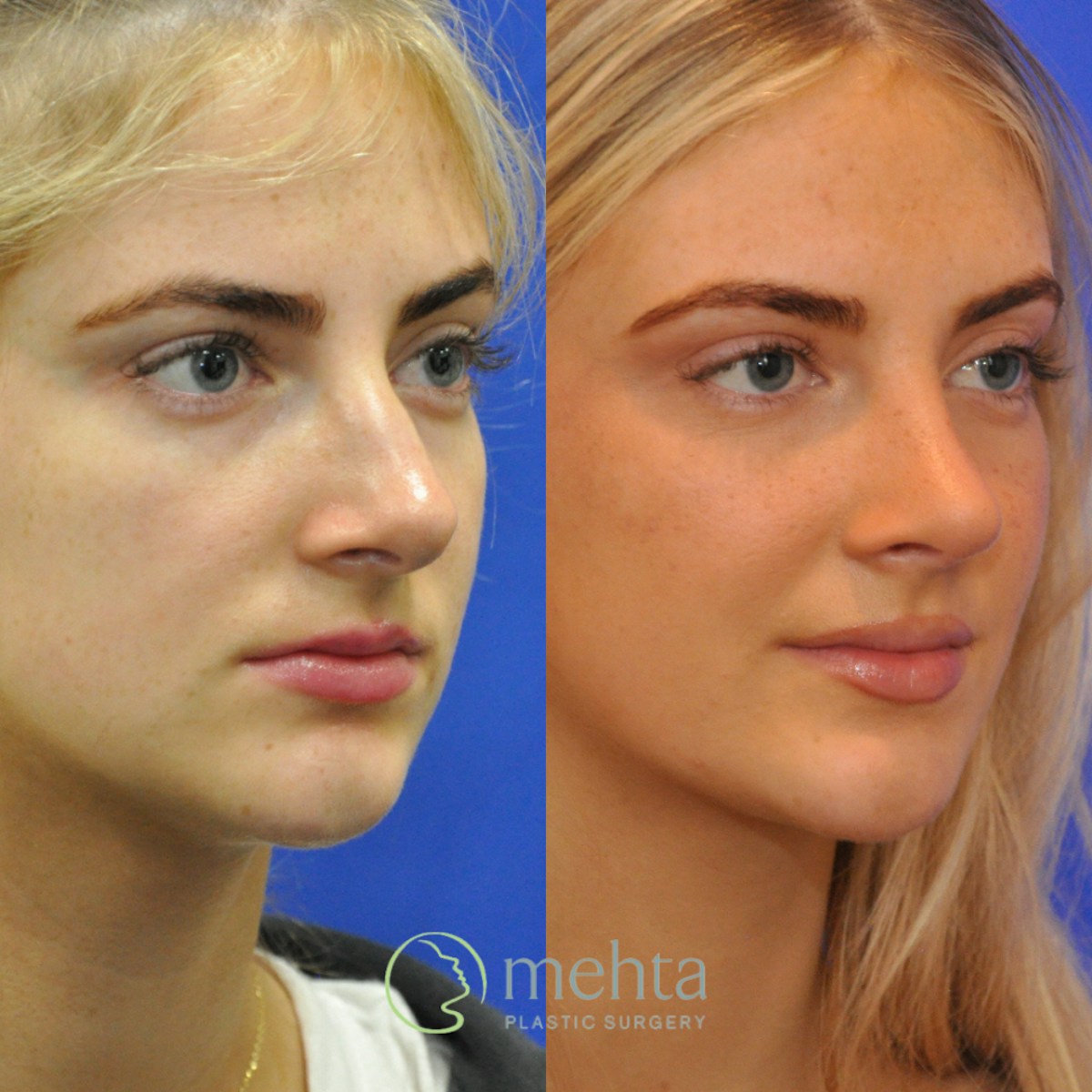 Rhinoplasty Before & After Gallery - Patient 564513 - Image 3