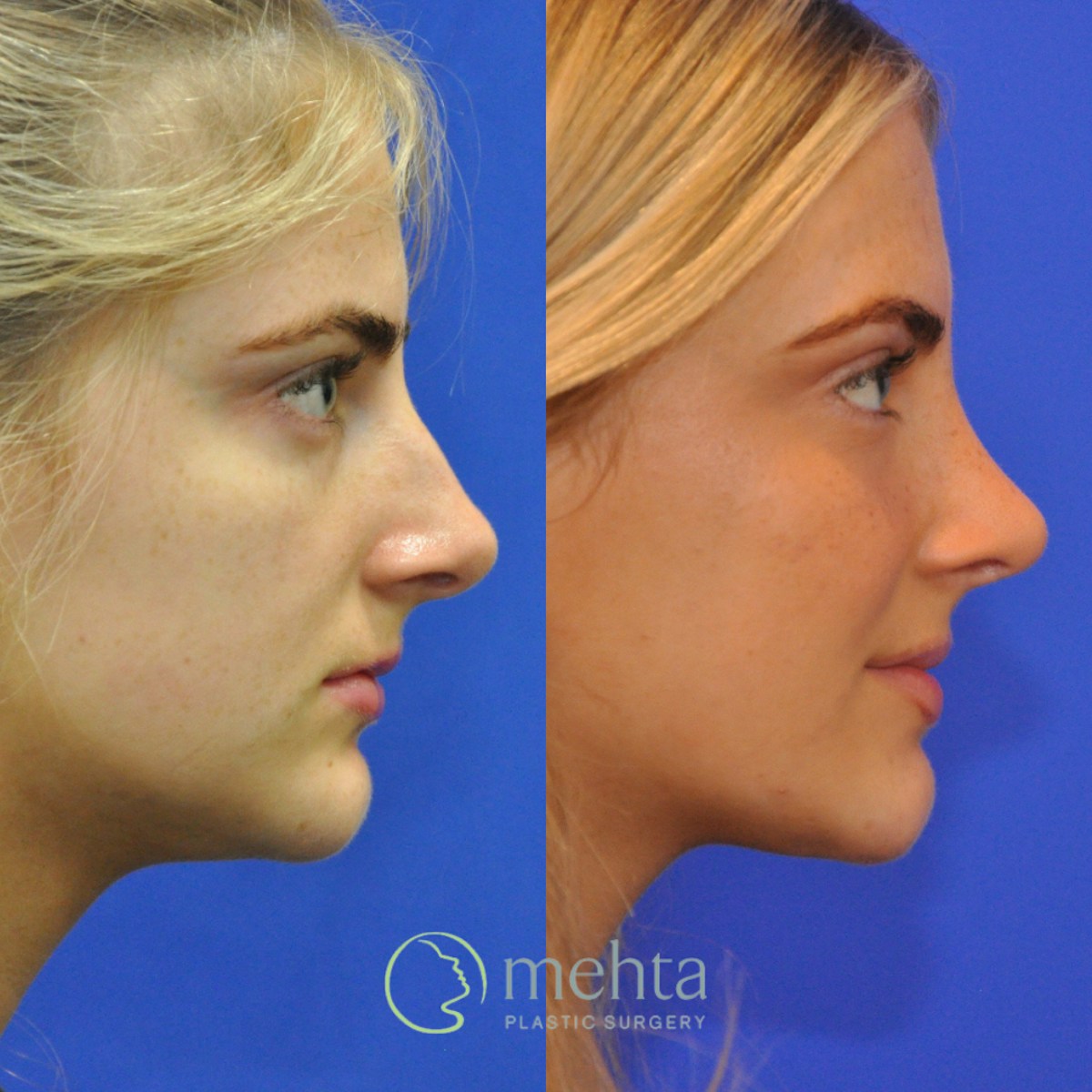 Rhinoplasty Before & After Gallery - Patient 564513 - Image 4