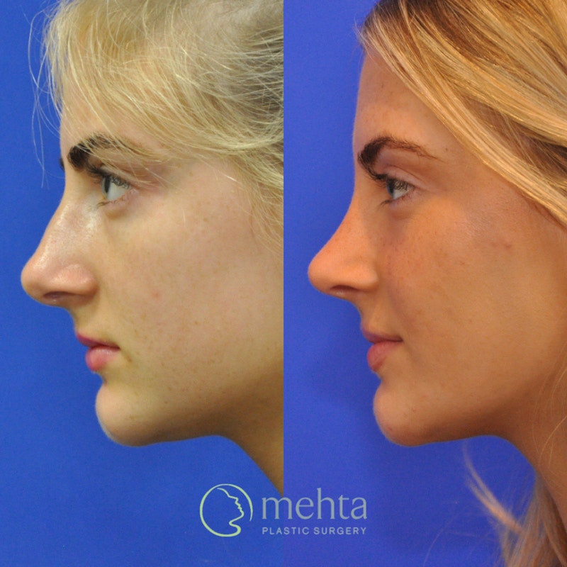 Rhinoplasty Before & After Gallery - Patient 564513 - Image 1