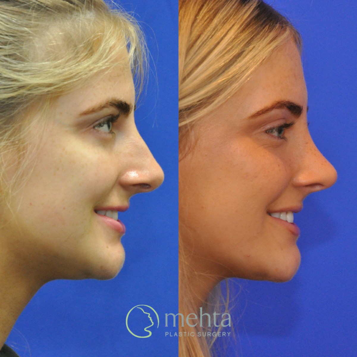 Rhinoplasty Before & After Gallery - Patient 564513 - Image 5